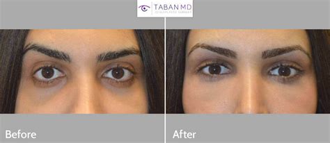 <b>Doctors</b> who perform <b>Canthoplasty</b> and Canthopexy in this region have an average rating of 4. . Best canthoplasty surgeon